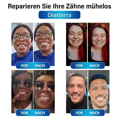 ✅Offizieller Shop | Instant Smile™ Blaulicht-Härtungslampe und Zahnersatzmaterialien✅CE-Kennzeichnung erhalten(Zur Reparatur von fehlenden Zähnen, gebrochenen Zähnen und Zahnlücken)🏥🏥