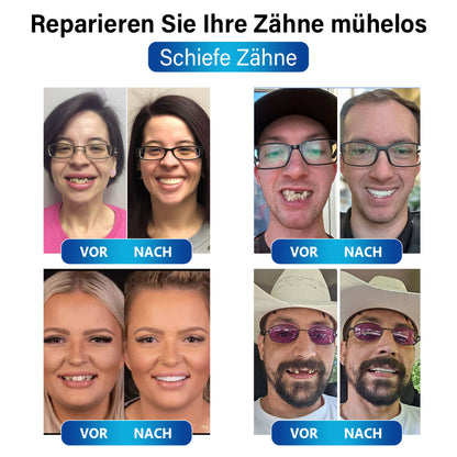 ✅Offizieller Shop | Instant Smile™ Blaulicht-Härtungslampe und Zahnersatzmaterialien✅CE-Kennzeichnung erhalten(Zur Reparatur von fehlenden Zähnen, gebrochenen Zähnen und Zahnlücken)🏥🏥